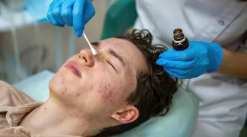 Which chemical peel is best for Indian skin
